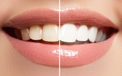 Cele mai populare tratamente de estetică dentară în 2025