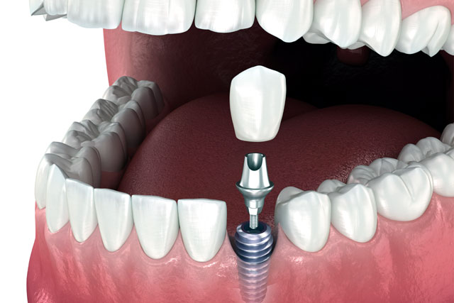 grafic implant dentar