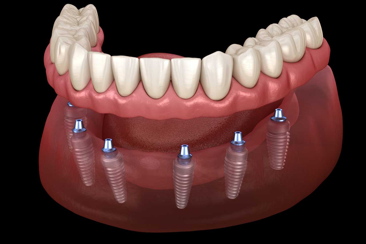 implant dentar all on 6