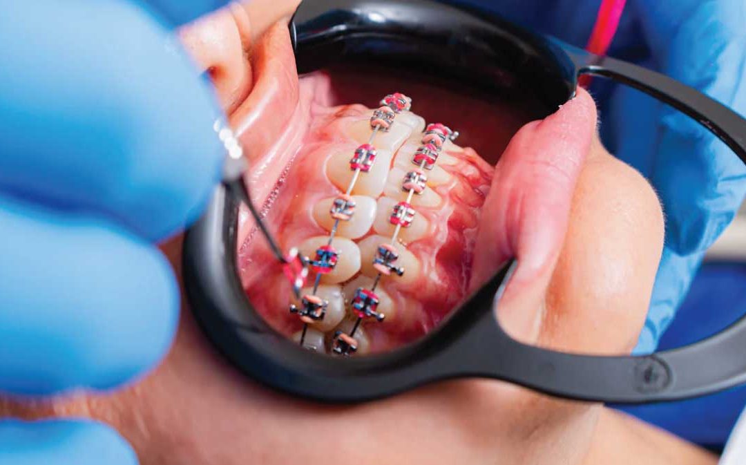 Ce tipuri de aparate dentare sunt disponibile și care sunt avantajele lor