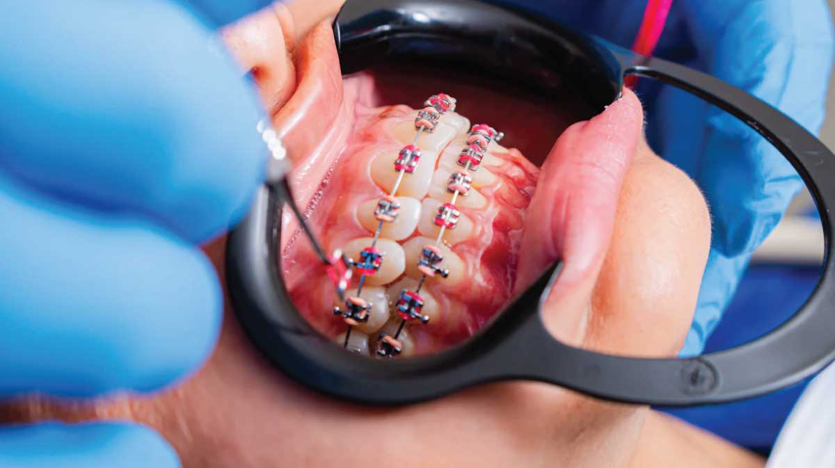 Aparat dentar - fixare