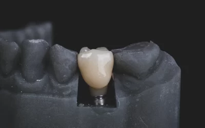 Secretele unei recuperări rapide după implant dentar în 2025