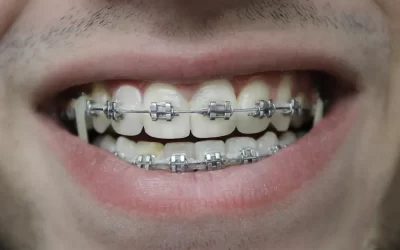 Sfaturi practice pentru igiena orală cu aparat dentar