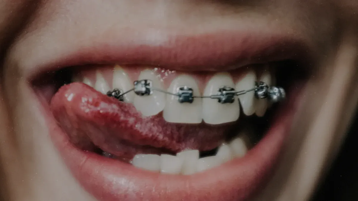 aparat dentar blog exq clinic cluj napoca