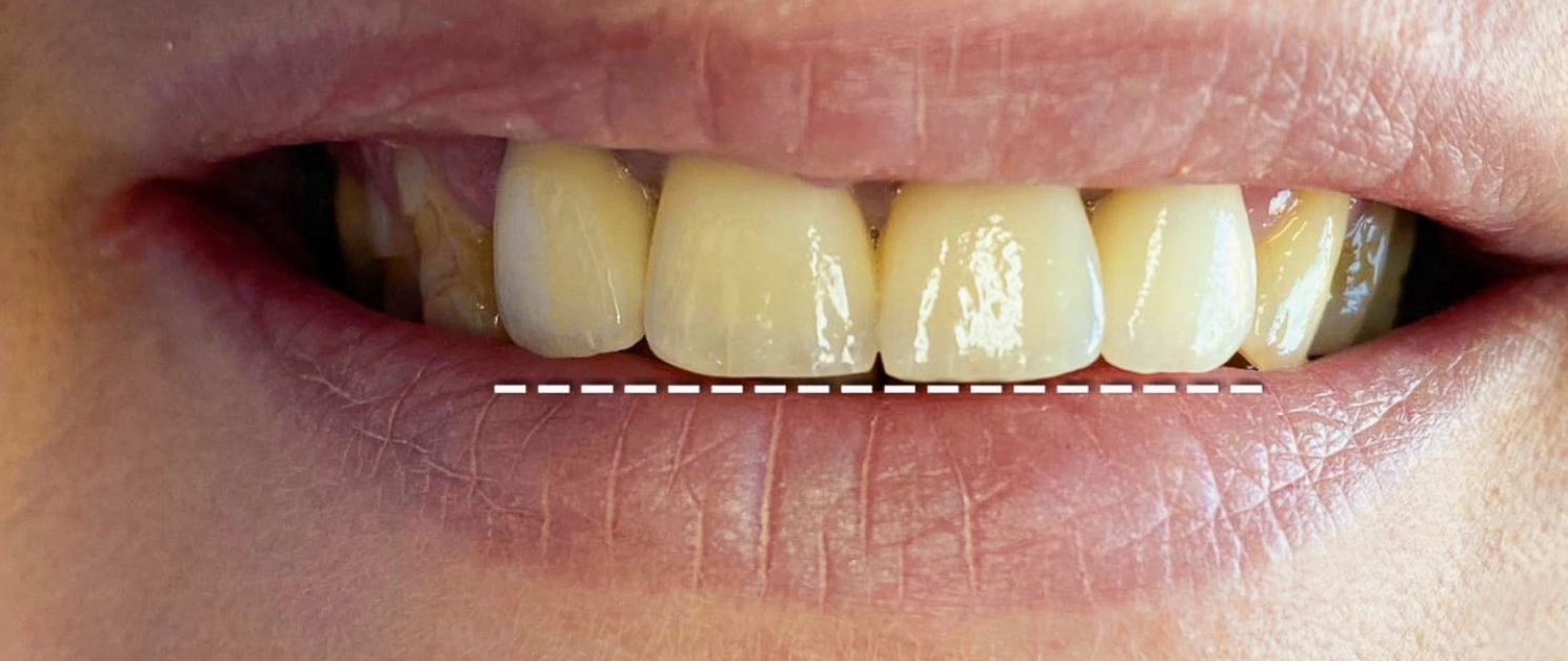 Coroane zirconiu aplicate