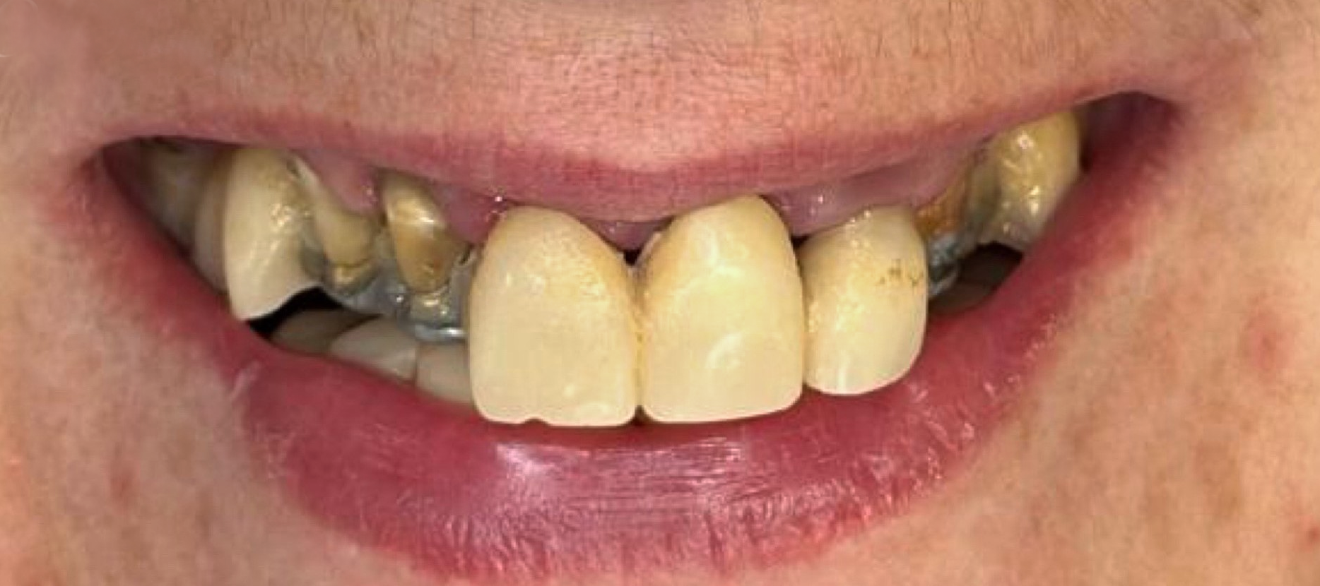 Zâmbet refăcut cu lucrare metalo-ceramică frontală