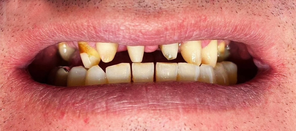 Lucrare metalo-ceramică înainte