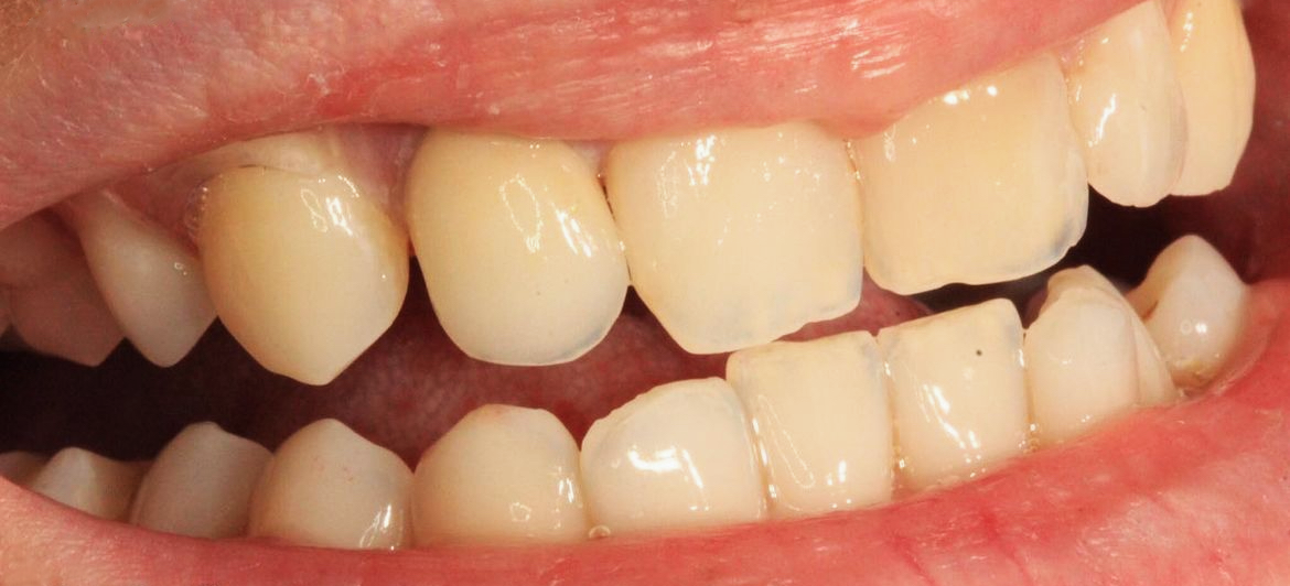 Reabilitare prin implanturi dentare cu proteză fixă