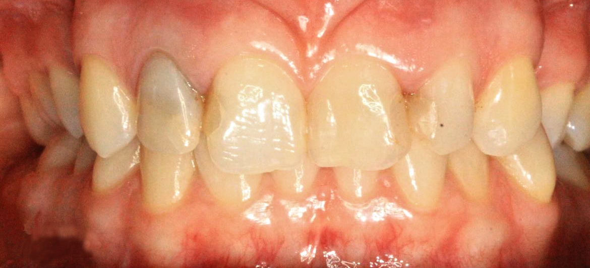 Reabilitare prin implanturi dentare cu proteză fixă