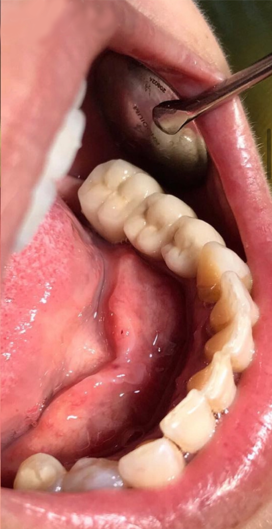 Refacere estetică laterală cu punte dentară