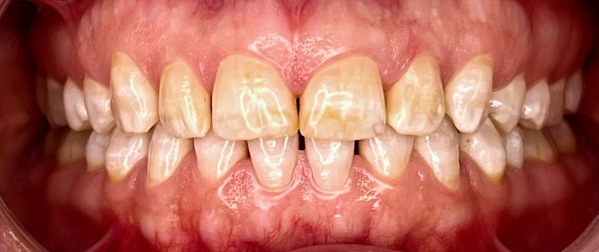 Zâmbet natural refăcut cu fațete dentare