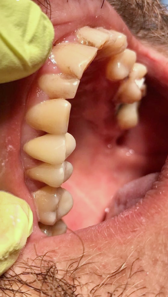 Dinte frontal reconstituit complet