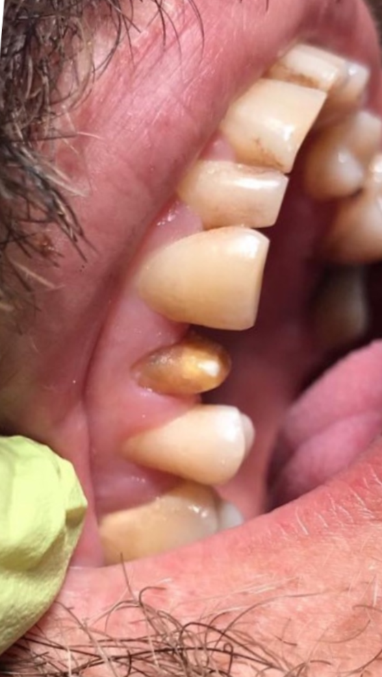 Dinte frontal reconstituit complet