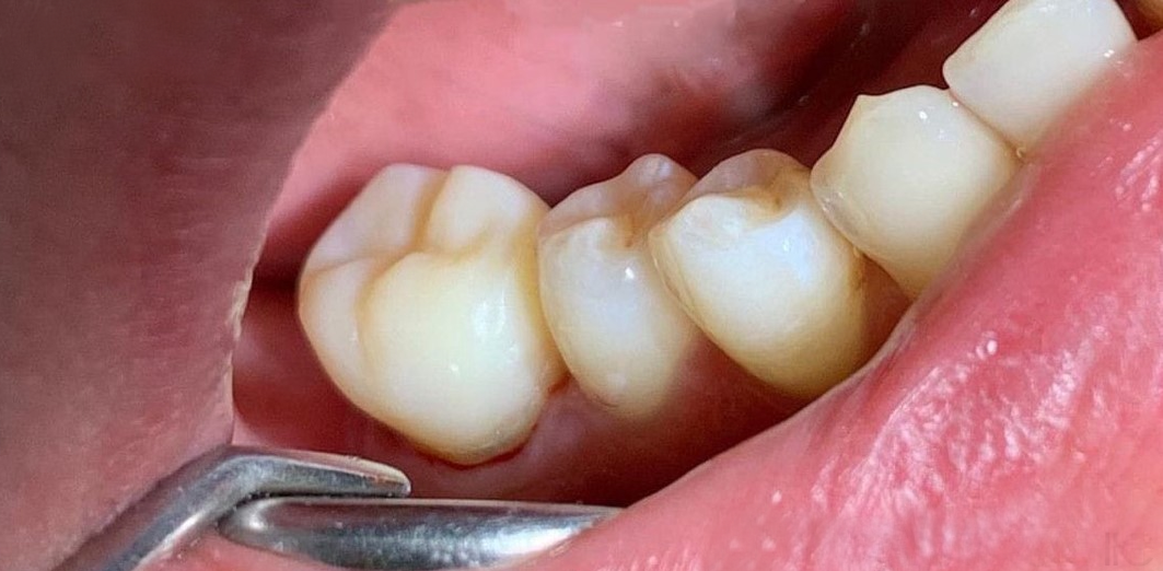 Refacere estetică molar cu digă