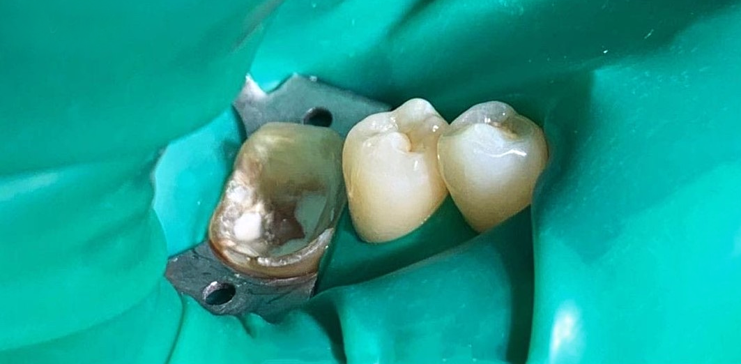 Refacere estetică molar cu digă