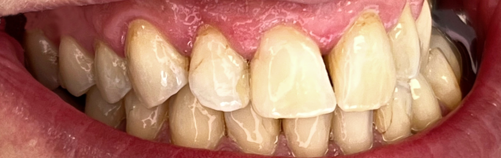 Rezultat reconstrucție dentară completă cu coroane