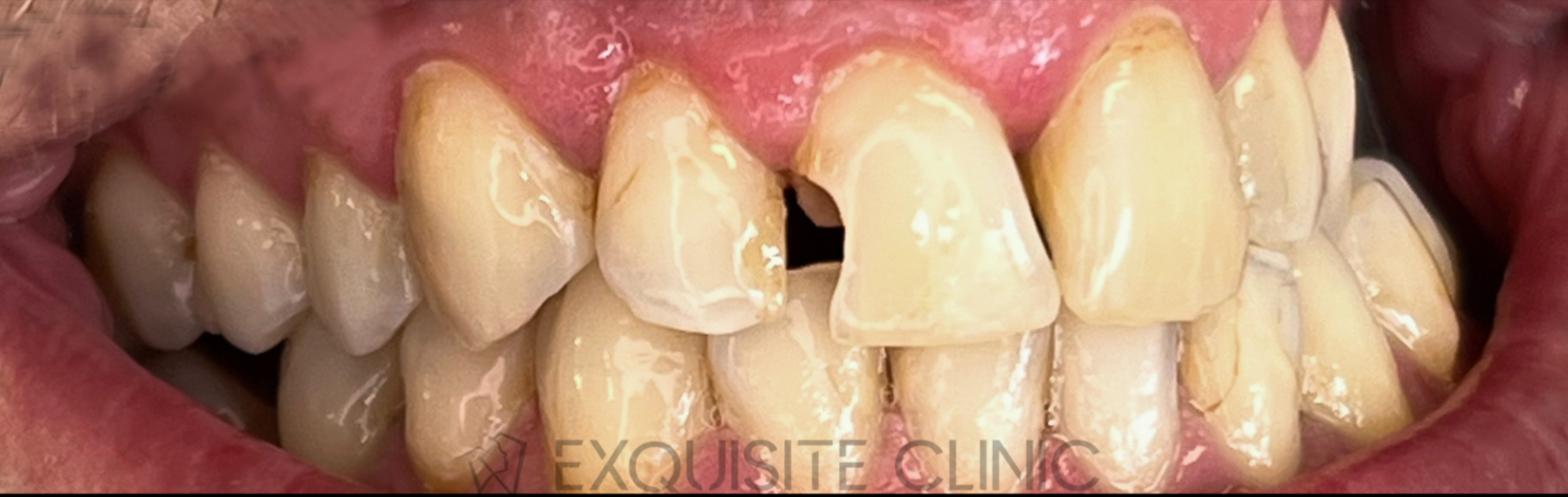 Rezultat reconstrucție dentară completă cu coroane